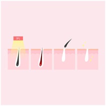 Xemos Silhouette Laser Hair Remover 351025 hero image