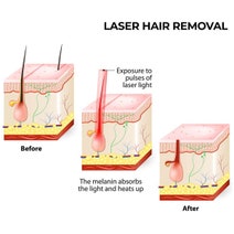 Xemos Silhouette Laser Hair Remover 351025 hero image